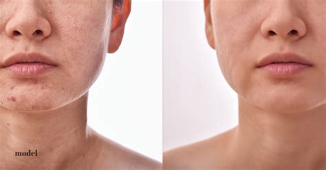 How To Plan Your Laser Skin Resurfacing Timeline | DermEffects London