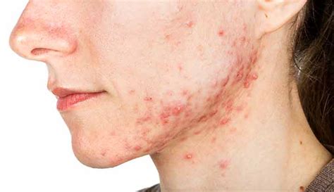 Cystic Acne: What Is It, Symptoms, Causes and Treatment