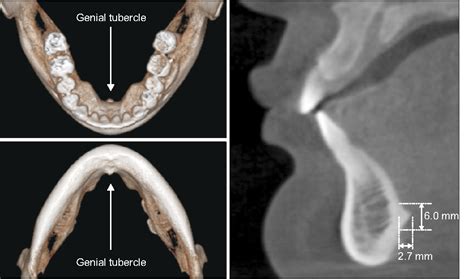 Radiographie Géniale Du Tubercule