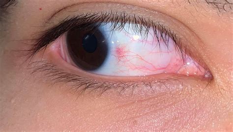 Why Do I Have A Red Spot On My Eye? - Yoors