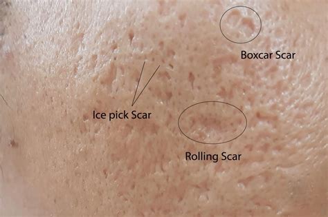 Atrophic Acne Scar