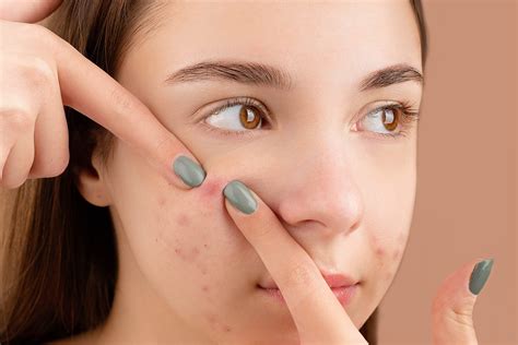 Les dangers de percer un bouton d'acné : les conséquences peuvent être désastreuses - Le ...