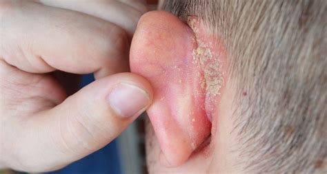 Seborrheic Eczema In Ear