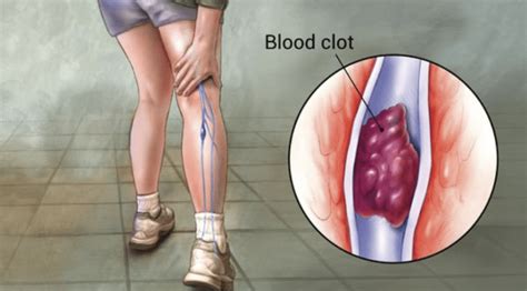 تجلط الدم وألم الساقين Leg pain …& deep venous thrombosis | الدكتور مازن كردية