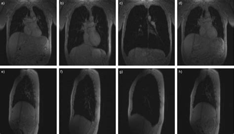 Lung hyperinflation: foe or friend? | European Respiratory Society