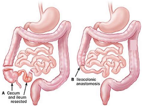 Anastomosis surgery, vascular anastomosis and bowel anastomosis