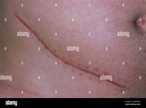 Appendicectomy scar on the abdomen of a patient. Appendicectomy, the ...