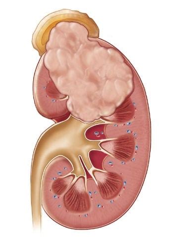 Tumor Symptoms: Symptoms Of Wilms Tumor