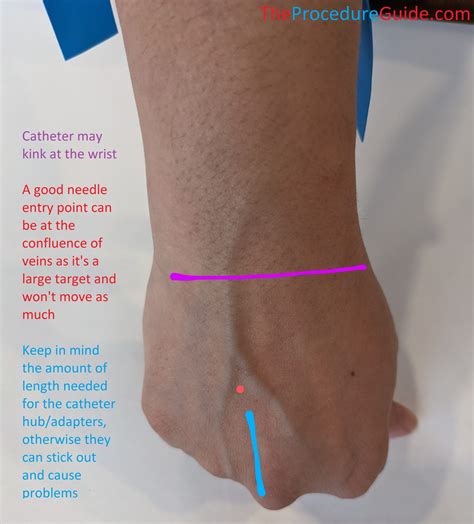 Intravenous Injection Sites