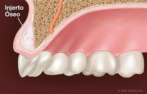 Ahora Complaciente Prosperar hueso en polvo para implantes dentales Pickering Gladys Clasificación