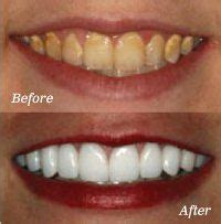 Professional Teeth Whitening Treatment in Burke, Virgina