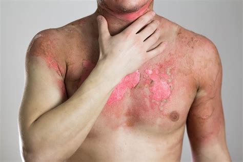 Burn Injury Scars Compensation – What Can I Expect?