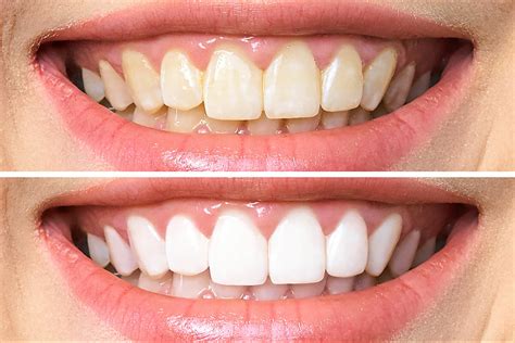 Cost of Teeth Whitening in Australia 2021 | Peel Dental Studio Dentist Mandurah