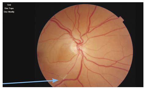 Time is vision in central retinal artery occlusion | Eye News