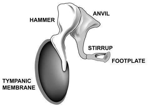 Otosclerosis | eNetMD