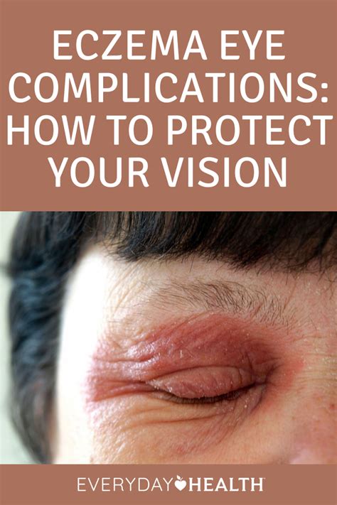 Eczema Eye Complications: How to Protect Your Vision | Everyday Health ...