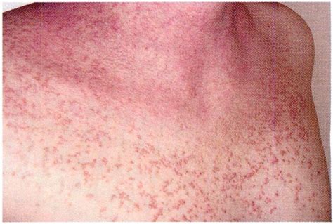 Heat Rash: All You Need to Know - Durofy - Business, Technology, Entertainment and Lifestyle ...