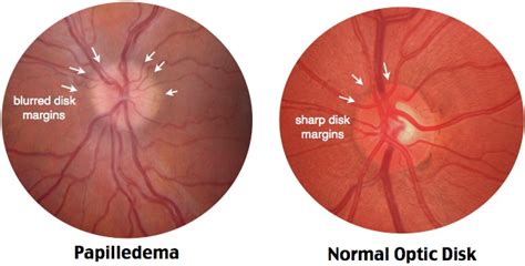 Optic Disc