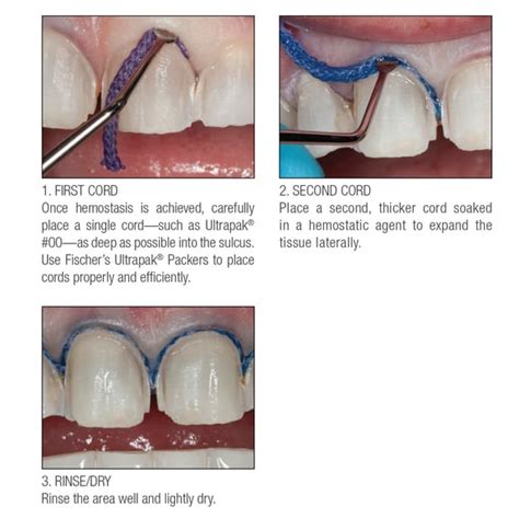 Mastering Retraction Cord Placement