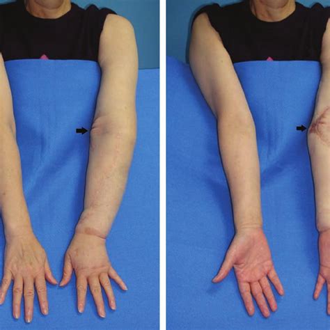 Preoperative view. the scar of previous vascularized groin lymph node... | Download Scientific ...