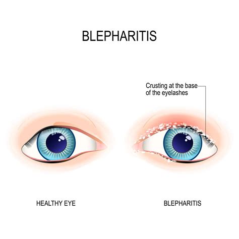 What is Blepharitis? - Henderson Eye Care