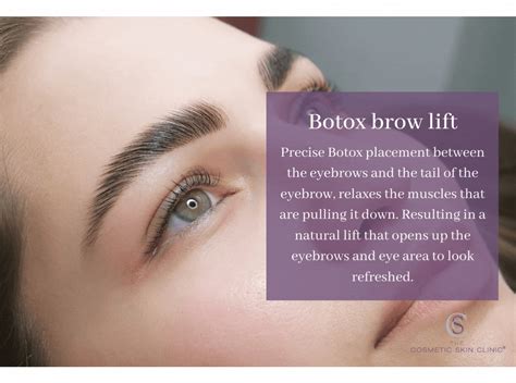 Botox Brow Lift: How it works, benefits and best clinic near me | Botox London, Buckinghamshire ...