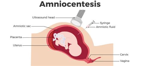 Amniocentesis Test in Pregnancy: Why Amniocentesis Is Performed, Risks & Accuracy