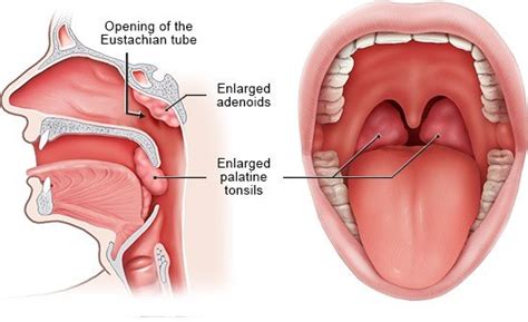 Enlarged tonsils and adenoids | informedhealth.org