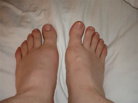 Feet Gout Pain at Rose Hill blog