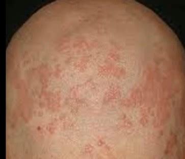 Pimples on scalp - treatment, causes, symptoms, pictures