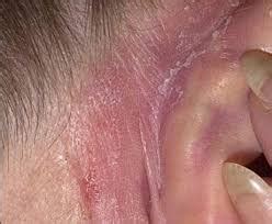 Itchy Ears - Symptoms Causes And Other Risk Factors