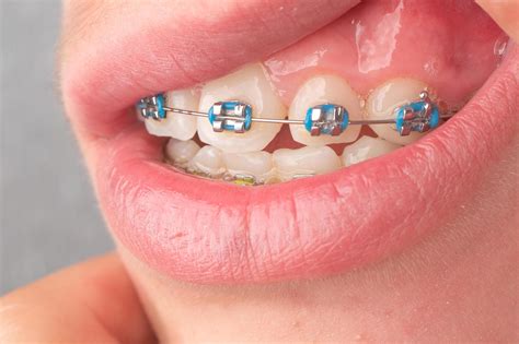 Braces with blue and yellow rubber bands close-up. 11771240 Stock Photo ...