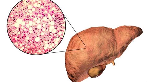 Tratamiento para esteatosis hepática en Tijuana | Ve las Opiniones