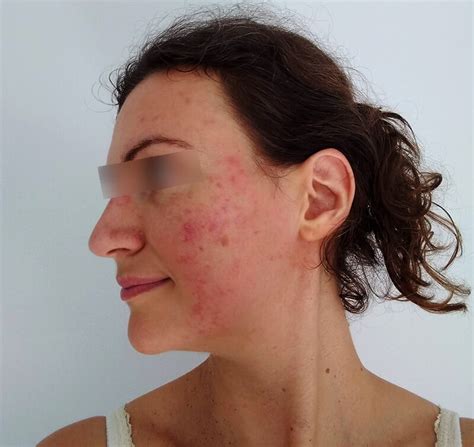 Q&A: How are Acne and the Papules and Pustules of Rosacea Different? | Rosacea.org