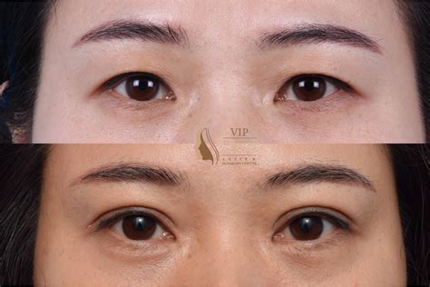 Upper Eyelid Surgery Los Angeles CA