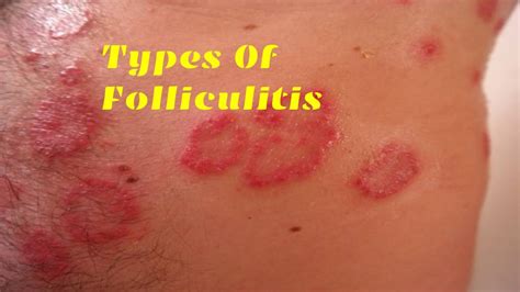 Folliculitis Types