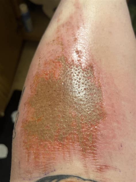 Road rash healing process : r/woundcare