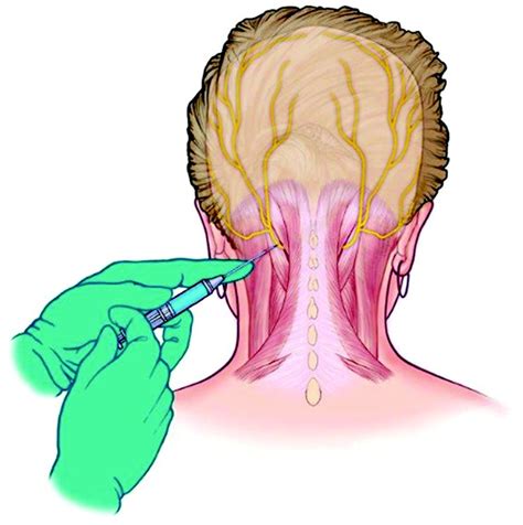 Greater Occipital Nerve Block for Acute Treatment of Migraine Headache: A Large Retrospective ...