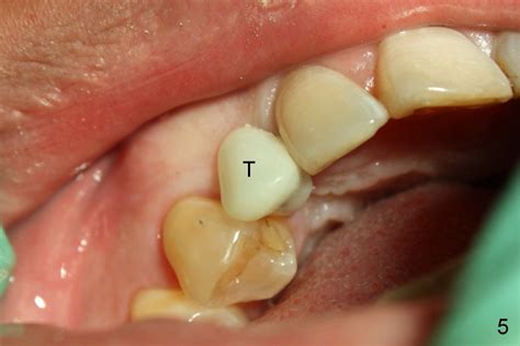 Immediate implant crown for congenitally missing canine, Dental Education Lecture