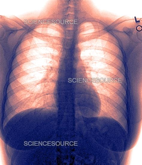 Photograph | Human Chest X-Ray | Science Source Images