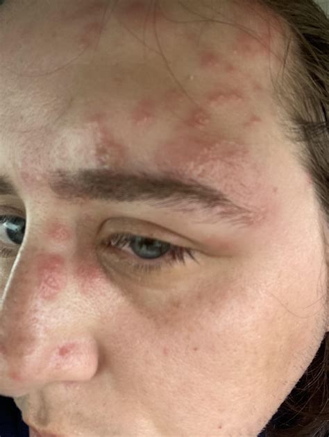 I got shingles… on my FACE. Part 2 : r/Wellthatsucks