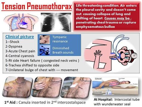 1000+ images about NCLEX on Pinterest | Heart disease, Left sided heart failure and Medical ...