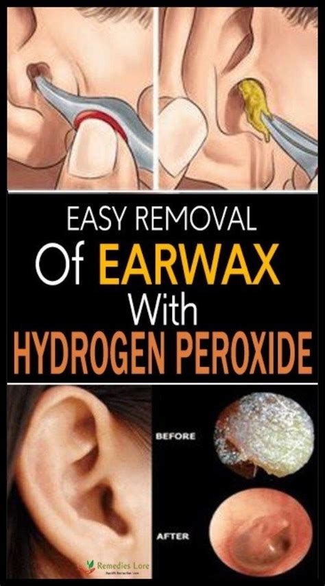 EASY REMOVAL OF EARWAX WITH HYDROGEN PEROXIDE – asezeeff.site | Ear wax, Ear wax removal ...