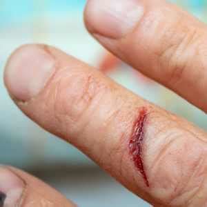 Laceration (Wound Care) - MedFriendly.com