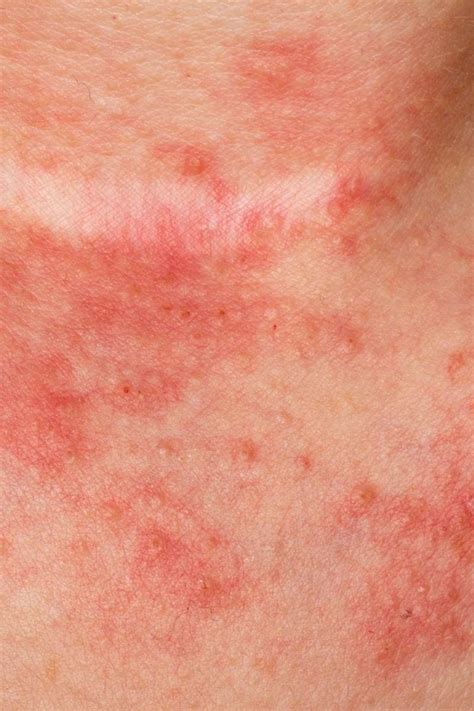 6 tipos de eczema: síntomas y causas