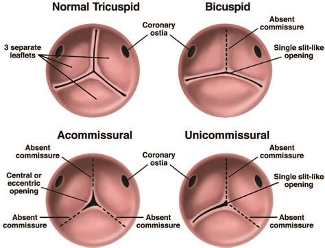 Figure 1 from 14 Unicuspid Aortic Valve | Semantic Scholar