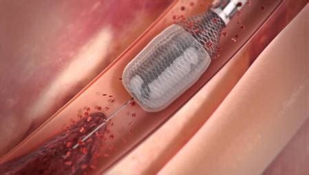 Mechanical Thrombectomy System - Interesting Engineering, News ...