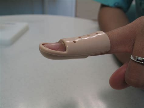 STACK THEM UP - The Mallet finger splint | The Orthopedics Malaysia blog