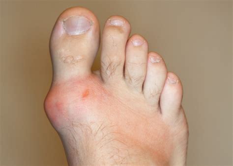 Arthrexin for Gout: A Comprehensive Guide to Treatment | Medmate