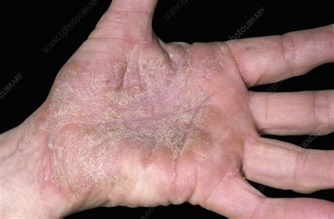 Palmar keratoderma on the hand - Stock Image - C049/4400 - Science Photo Library